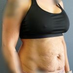 Abdominoplasty Before & After Patient #2053