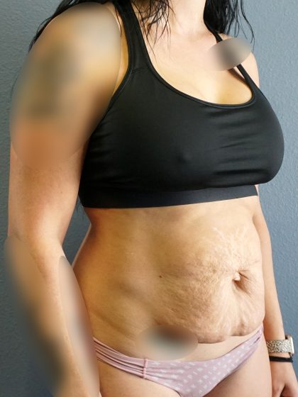 Abdominoplasty Before & After Patient #2053