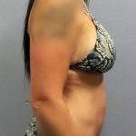 Abdominoplasty Before & After Patient #2053