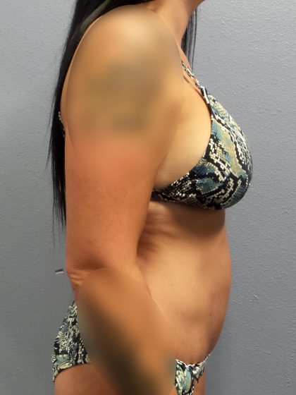 Abdominoplasty Before & After Patient #2053