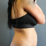 Abdominoplasty Before & After Patient #2053