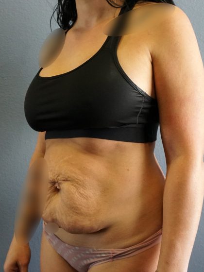 Abdominoplasty Before & After Patient #2053