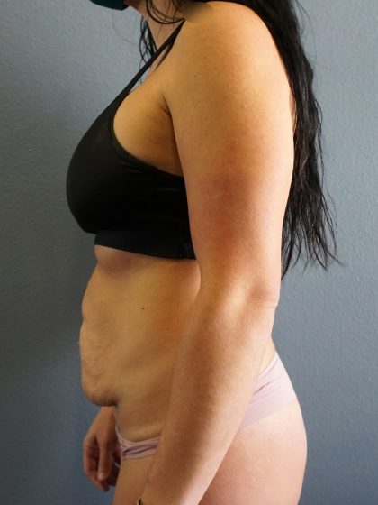 Abdominoplasty Before & After Patient #2053