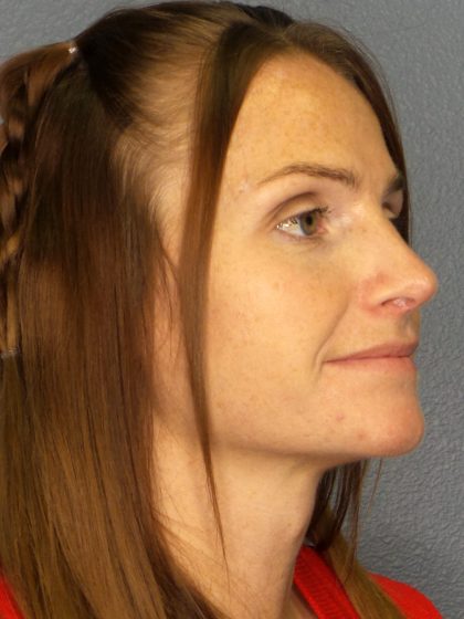 Revision Rhinoplasty Before & After Patient #283