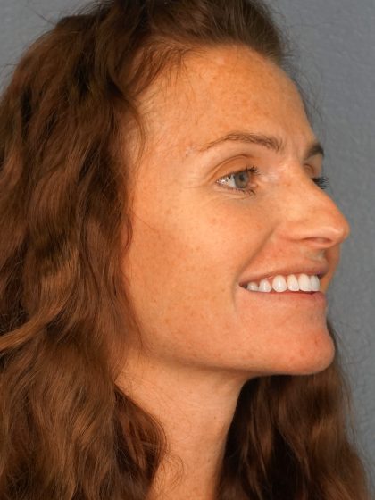 Revision Rhinoplasty Before & After Patient #283