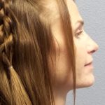 Revision Rhinoplasty Before & After Patient #283
