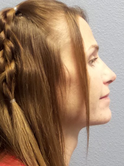 Revision Rhinoplasty Before & After Patient #283