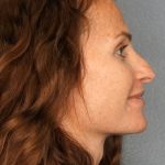 Revision Rhinoplasty Before & After Patient #283