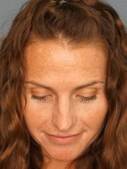 Revision Rhinoplasty Before & After Patient #283
