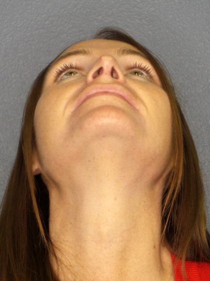 Revision Rhinoplasty Before & After Patient #283