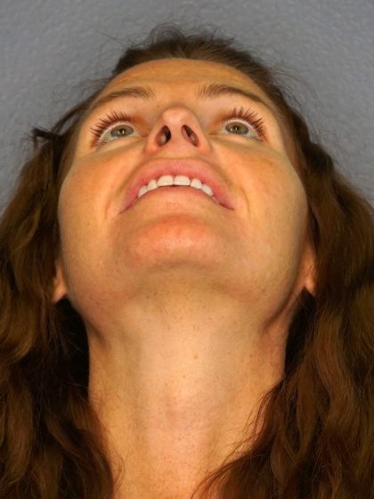 Revision Rhinoplasty Before & After Patient #283