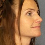 Rhinophyma Before & After Patient #1369