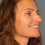Rhinoplasty Before & After Patient #558