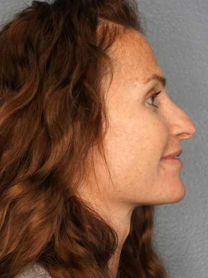 Rhinoplasty Before & After Patient #558