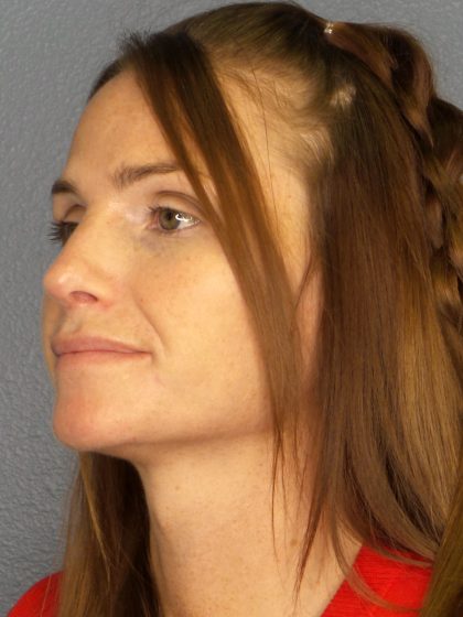Rhinoplasty Before & After Patient #558