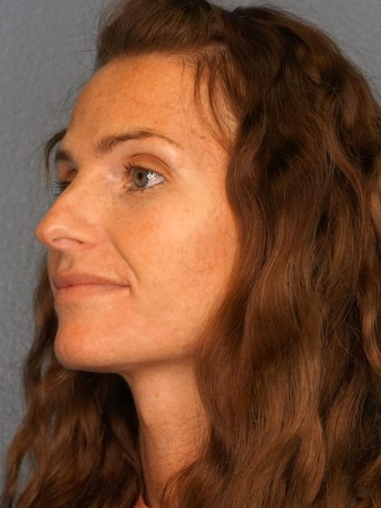 Rhinoplasty Before & After Patient #558