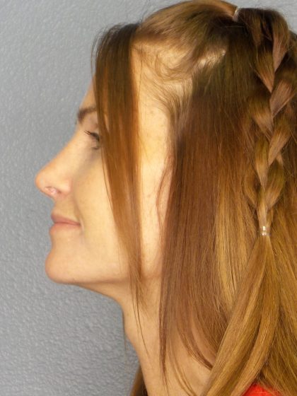 Rhinoplasty Before & After Patient #558