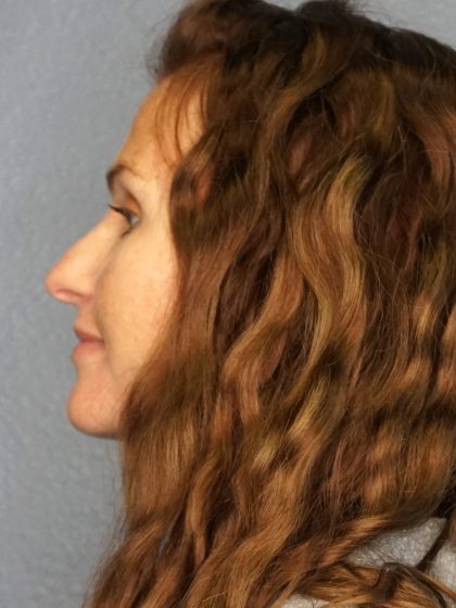 Rhinoplasty Before & After Patient #558
