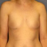 Breast Augmentation Before & After Patient #1781