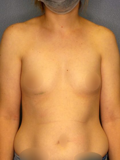Breast Augmentation Before & After Patient #1781