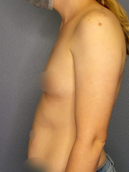 Breast Augmentation Before & After Patient #1781