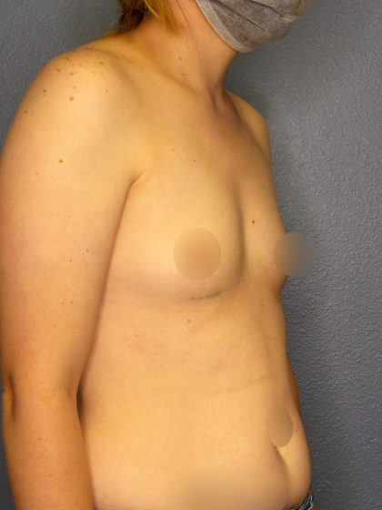 Breast Augmentation Before & After Patient #1781