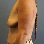 Breast Lift with Implant (Augmentation Mastopexy) Before & After Patient #987