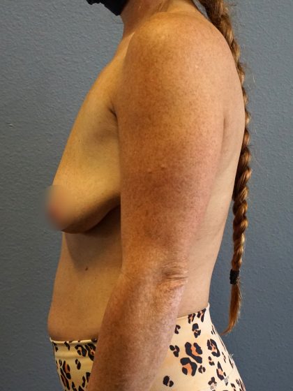 Breast Lift with Implant (Augmentation Mastopexy) Before & After Patient #987