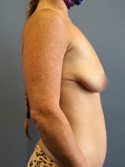 Breast Lift with Implant (Augmentation Mastopexy) Before & After Patient #987