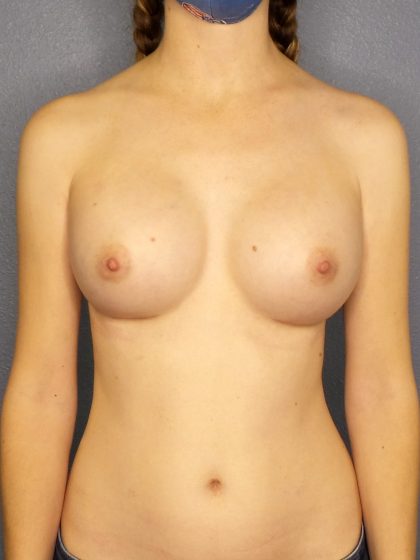 Breast Augmentation Before & After Patient #1586