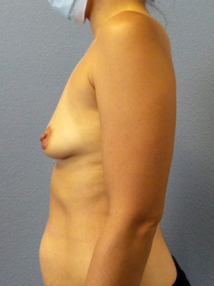 Breast Augmentation Before & After Patient #1422
