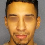 Revision Rhinoplasty Before & After Patient #268