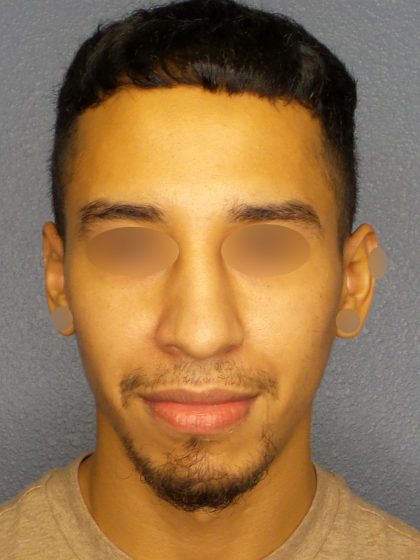 Revision Rhinoplasty Before & After Patient #268