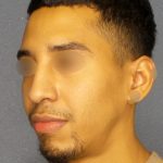 Revision Rhinoplasty Before & After Patient #268