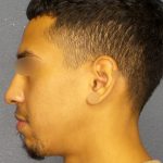 Revision Rhinoplasty Before & After Patient #268