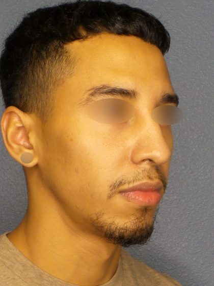 Revision Rhinoplasty Before & After Patient #268