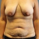 Mommy Makeover Before & After Patient #1946