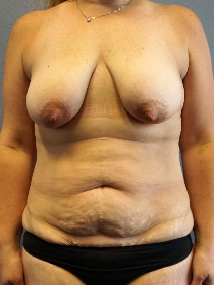 Mommy Makeover Before & After Patient #1946