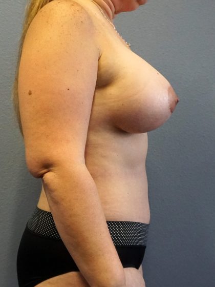 Mommy Makeover Before & After Patient #1946