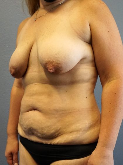 Mommy Makeover Before & After Patient #1946