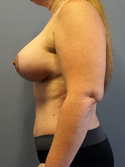 Mommy Makeover Before & After Patient #1946