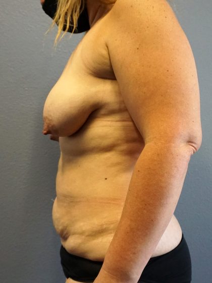 Mommy Makeover Before & After Patient #1946
