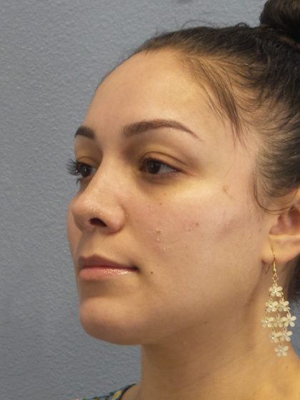 Revision Rhinoplasty Before & After Patient #257