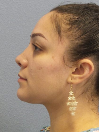 Revision Rhinoplasty Before & After Patient #257