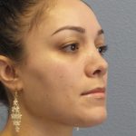 Rhinophyma Before & After Patient #1343