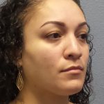 Rhinophyma Before & After Patient #1343