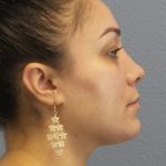 Rhinophyma Before & After Patient #1343