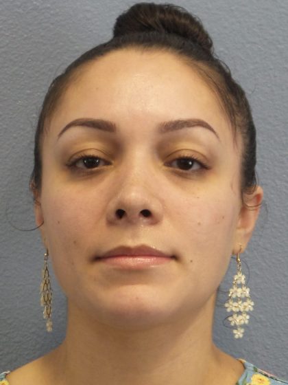 Rhinoplasty Before & After Patient #532