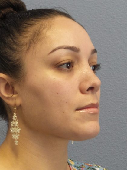 Rhinoplasty Before & After Patient #532