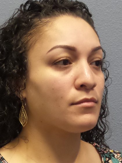 Rhinoplasty Before & After Patient #532